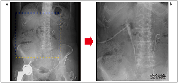 図8　i-fluoroの使用例：右腎瘻カテーテル交換症例
