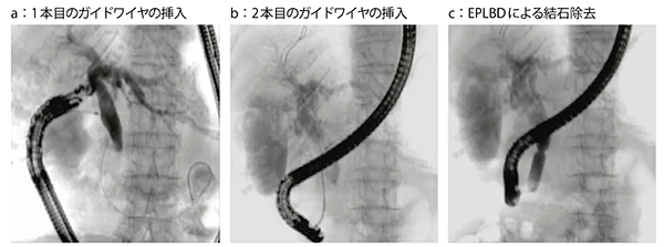 図1　症例1：傍乳頭憩室（開口部位不明）に対するrendezvous法