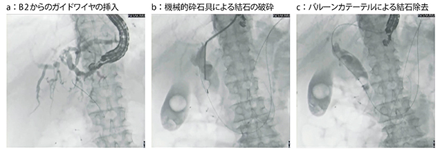 図4　症例3：乳頭到達困難症例へのEUS下順行性結石除去