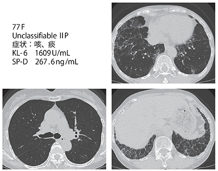 図4　症例1：器質化肺炎（77歳、女性）