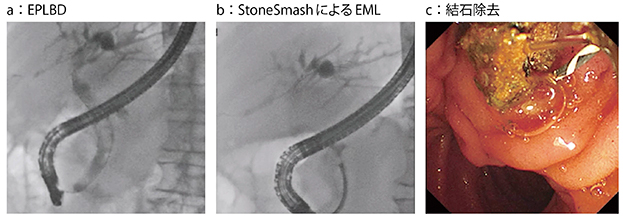 図1　症例1：大結石に対するEPLBD＋EML