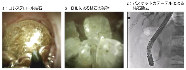 図2　症例2：三管合流部の胆管結石嵌頓症例へのEHL