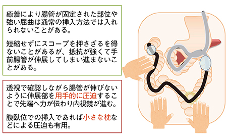 図4　内視鏡挿入のコツ：用手圧迫の併用