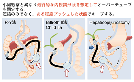 図5　オーバーチューブの固定位置