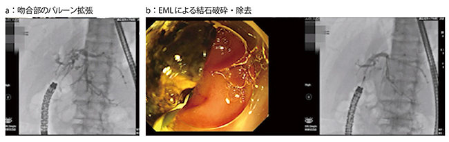 図6　症例4：SSPPDⅡA-1再建症例の胆管結石に対するEML