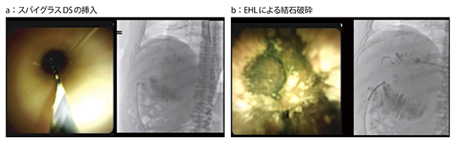図7　症例5：SSPPDⅡA-1再建症例に対する経口胆道鏡＋EHLの工夫