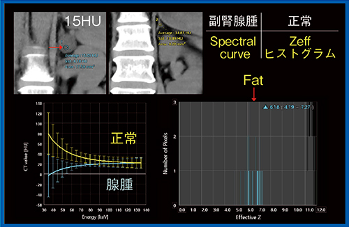 図2　副腎腺腫