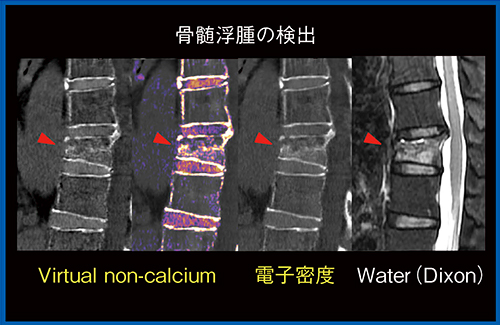 図5　新鮮椎体圧迫骨折