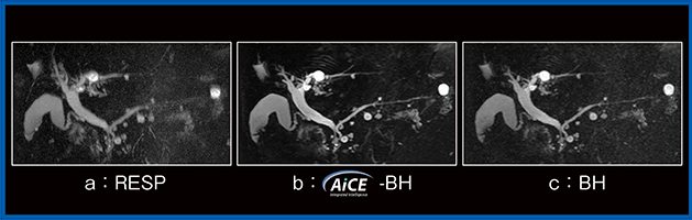 図2　3D-MRCPにおけるAiCE適用の有無による画像比較 （画像ご提供：国際医療福祉大学・田島　拓先生）