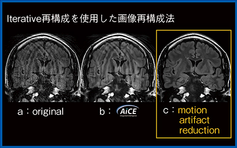 図6　Motion artifact reductionによるアーチファクト除去