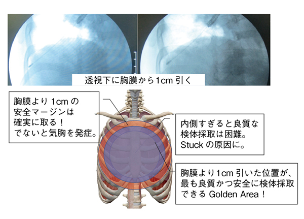 図3　クライオバイオプシーで求められる技術