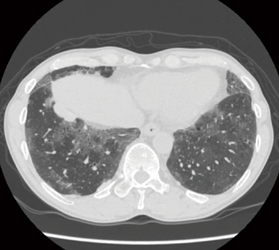 図8　症例1：すりガラス陰影を呈するILD疑い