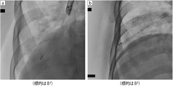図9　症例1：RAOでの観察 a：RAO41°、b：RAO29°、パルス透視15fps、新画像処理条件