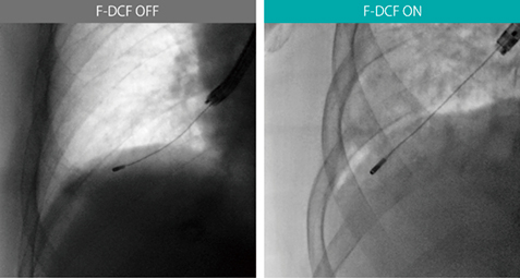 図12　透視デジタル補償フィルタ（F-DCF）ON/OFFの比較 パルス透視15fps クライオプローブ：1.9mm（ERBE社製） F-DCF OFF：正面、F-DCF ON：RAO41°