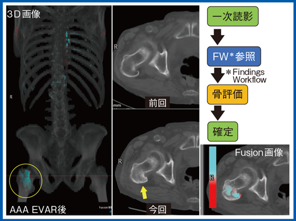 図5 症例5:80歳代,男性,AAAのEVAR後,大腿骨骨折 図5 症例5:80歳代,男性,AAAのEVAR後,大腿骨骨折