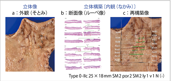 図4　立体像から立体構築を類推する（症例）