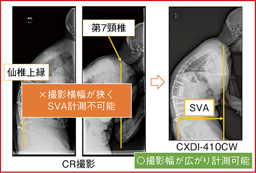 図2　CRとCXDI-410CWによるSVAの計測1）