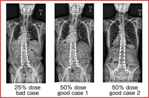 図3　50％線量の全脊椎正面像2）