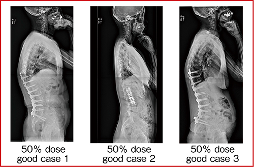 図4　50％線量の全脊椎側面像2）