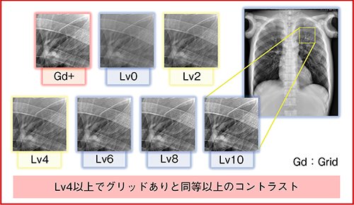 図1　散乱線低減処理レベルの変化に伴うコントラストの変化