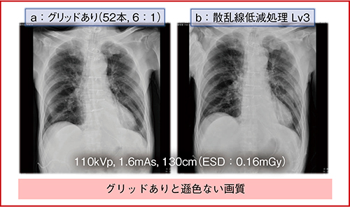 図2　胸部ポータブル撮影