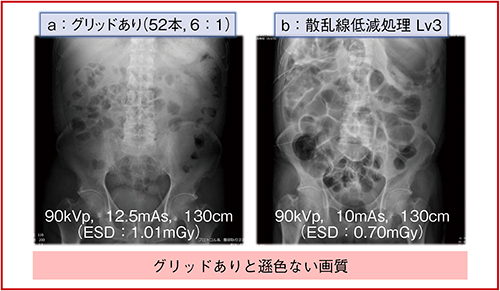 図3　腹部ポータブル撮影