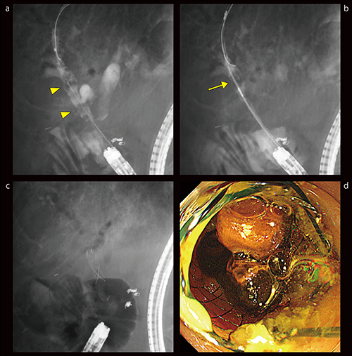 図9　症例4：胆道再建後の治療に難渋した肝内結石症例（77歳、男性）