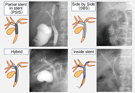 図8　非切除肝門部胆管狭窄のドレナージ法