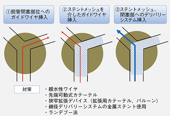 図9　Partial stent in stent（PSIS）法が手技困難である要因