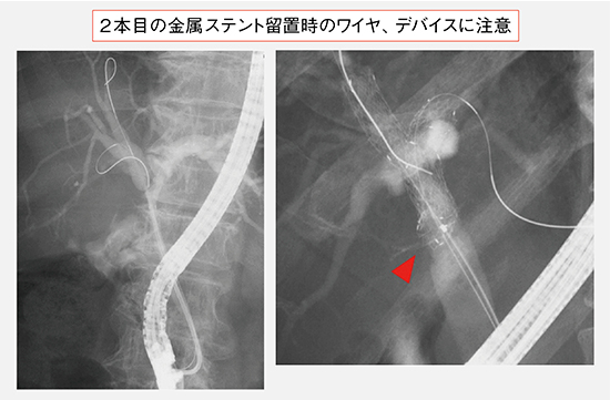 図11　PSIS施行時のレーザーカット型金属ステント留置の注意点