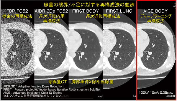 図5　線量の限界/不足に対する再構成法の進歩とディープラーニングを用いた画像再構成の有用性