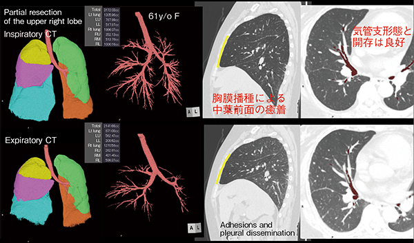 図15　症例3：右肺上葉部分切除後（61歳、女性）