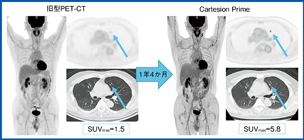 図9　症例3：50歳代，男性，甲状腺がん肺転移