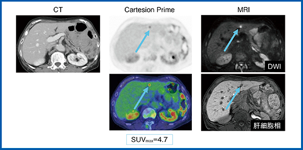 図11　症例5：60歳代，女性，子宮体がん肝転移