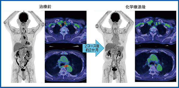 図12　症例6：80歳代，男性，食道がんの治療効果判定