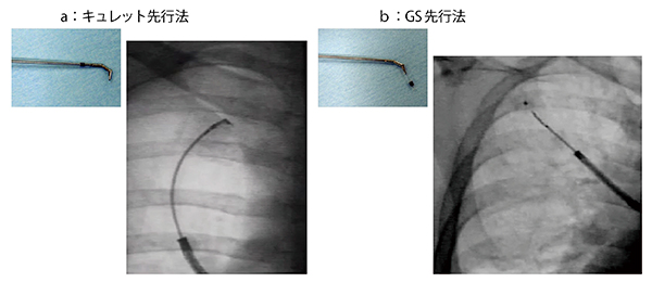 図1　GSをキュレット誘導する場合のキュレット屈曲方向の確認