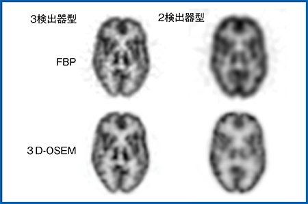 図2　3D-OSEM法（コリメータ開口補正）