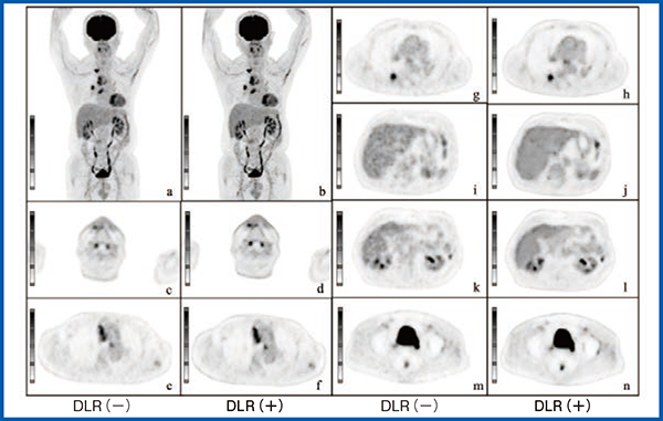 図2　DLRが有用であった代表的な症例：67歳，男性，転移性肺がん a，b：MIP像　c，d：頸部　e，f：胸部・縦隔リンパ節転移　g，h：胸部・肺転移 i，j：肝臓　k，l：腎臓　m，n：膀胱 （参考文献1）より引用転載）