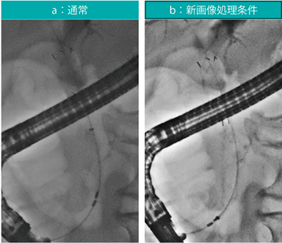 図7　金属ステント使用例 パルス透視15fps ステント：Niti-S Biliary stent（アンカバード、10mm×80mm、センチュリーメディカル社製）