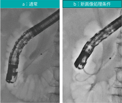 図8　自然脱落式膵管ステント使用例 パルス透視15fps ステント(膵管)：Advanix Pancreatic Stent（ピックテール、5Fr、5cm、ボストン・サイエンティフィック社製）