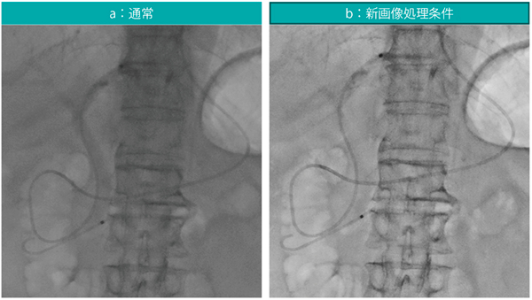 図9　細径ENBD留置チューブ使用例 パルス透視7.5fps ステント：Advanix Pancreatic Stent（ピックテール、5Fr、5cm、ボストン・サイエンティフィック社製）、ドレナージチューブ：6Fr ENBDチューブ（オリンパス社製）