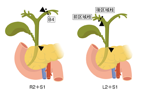図4　胆管生検を行う部位