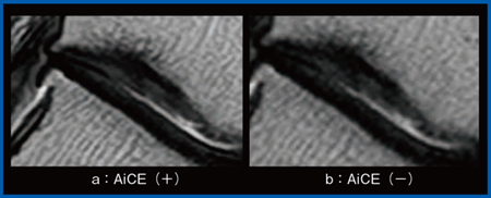 図2　AiCEによる関節軟骨深部損傷の描出