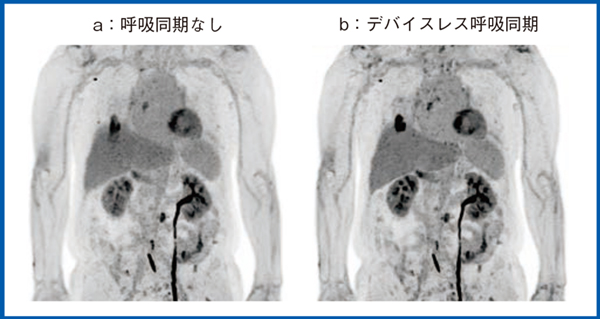 図12　デバイスレス呼吸同期の適用