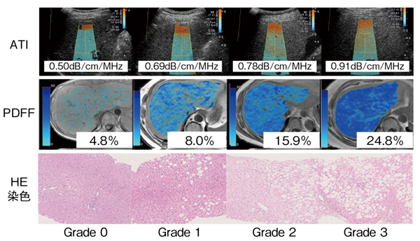 図2　ATI，MRI-PDFF，HE染色の比較