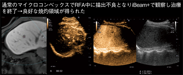 図3　症例3：胃GIST術後肝内転移疑い