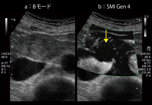 図5　SMI Gen 4による血流評価（膵頭部SPN）