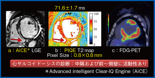 図1 症例1における活動性の評価 図1 症例1における活動性の評価