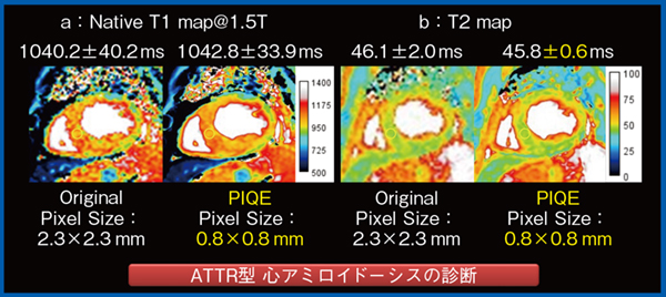 図2 症例2:T1 / T2値による心アミロイドーシスの病型評価 図2 症例2:T1 / T2値による心アミロイドーシスの病型評価