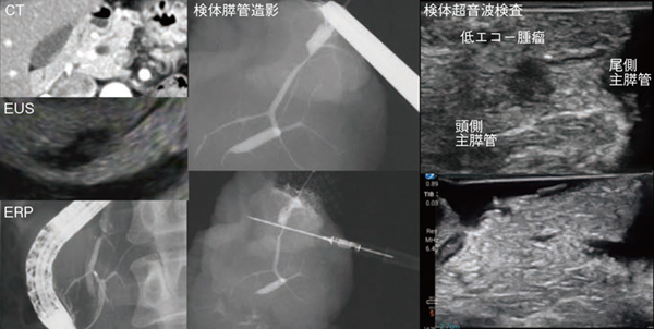 図1 標本造影/超音波検査を行った症例 主膵管狭窄を伴う6mm大の腫瘤病変がセロトニン産生性PanNET G1と確認できた。 図1 標本造影/超音波検査を行った症例 主膵管狭窄を伴う6mm大の腫瘤病変がセロトニン産生性PanNET G1と確認できた。